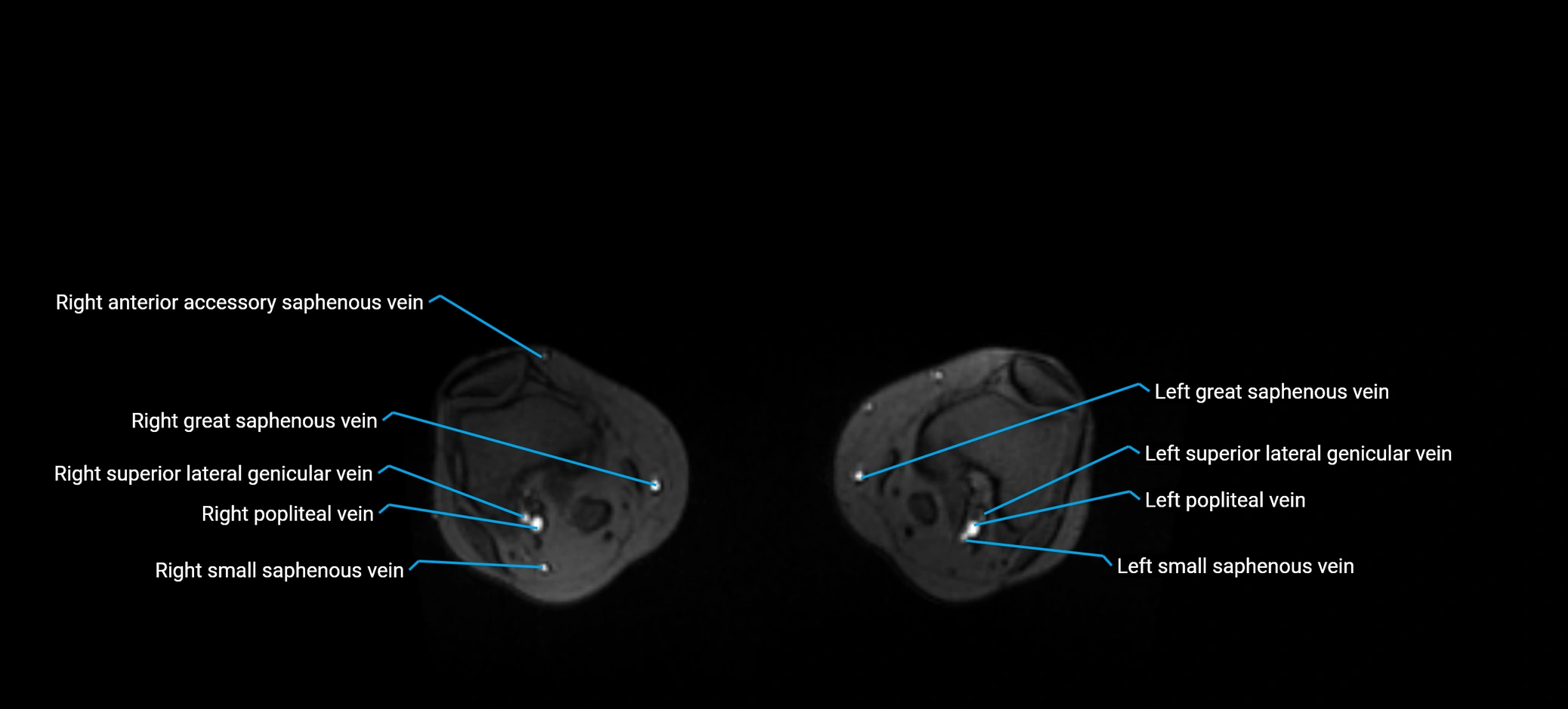 MRV abdomen pelvis & lower limb axial cross sectional anatomy labelled MRI image 358.webp